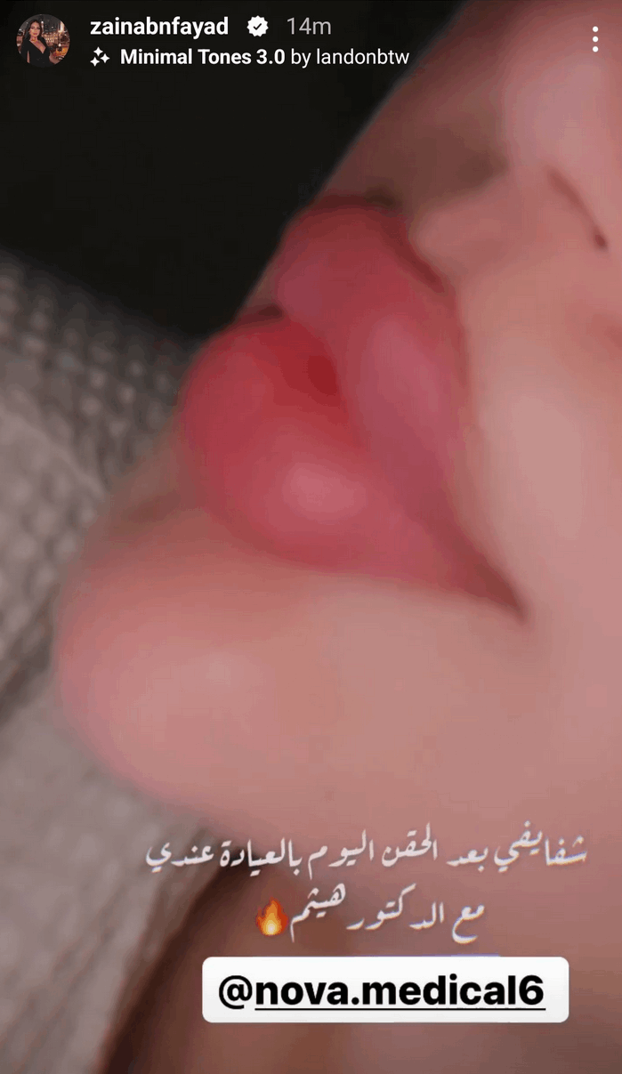 ابنة هيفا وهبي توثق خضوعها لعملية تجميل جديدة ..شاهدوا كيف بدت (صورة) ابنة هيفا وهبي توثق خضوعها لعملية تجميل جديدة ..شاهدوا كيف بدت (صورة)