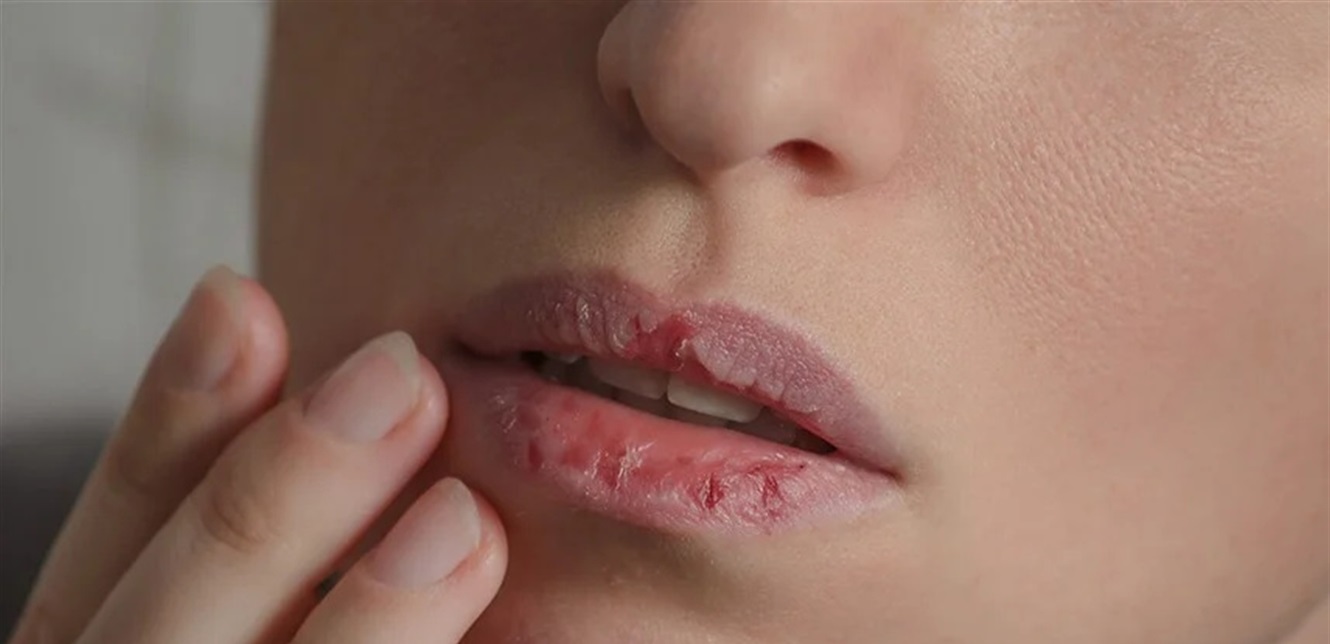 تشققات الشفاه المستمرة.. اكثر من مجرد جفاف
