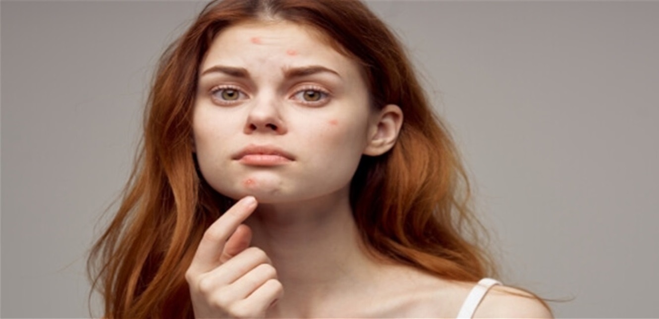 لماذا يزداد حب الشباب في الشتاء؟ حلول فعّالة للحفاظ على صحة البشرة