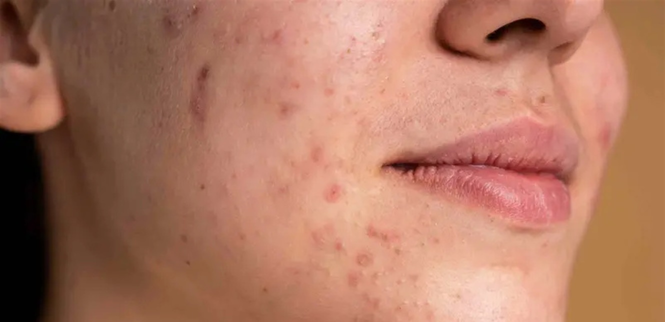 عدو الشتاء الخفي.. لماذا يهاجم حب الشباب بشرتكِ مع برودة الجو؟