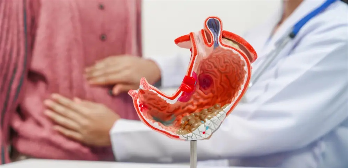 آخر تحليل يتحدث عن سرطان القولون.. ماذا كشف؟