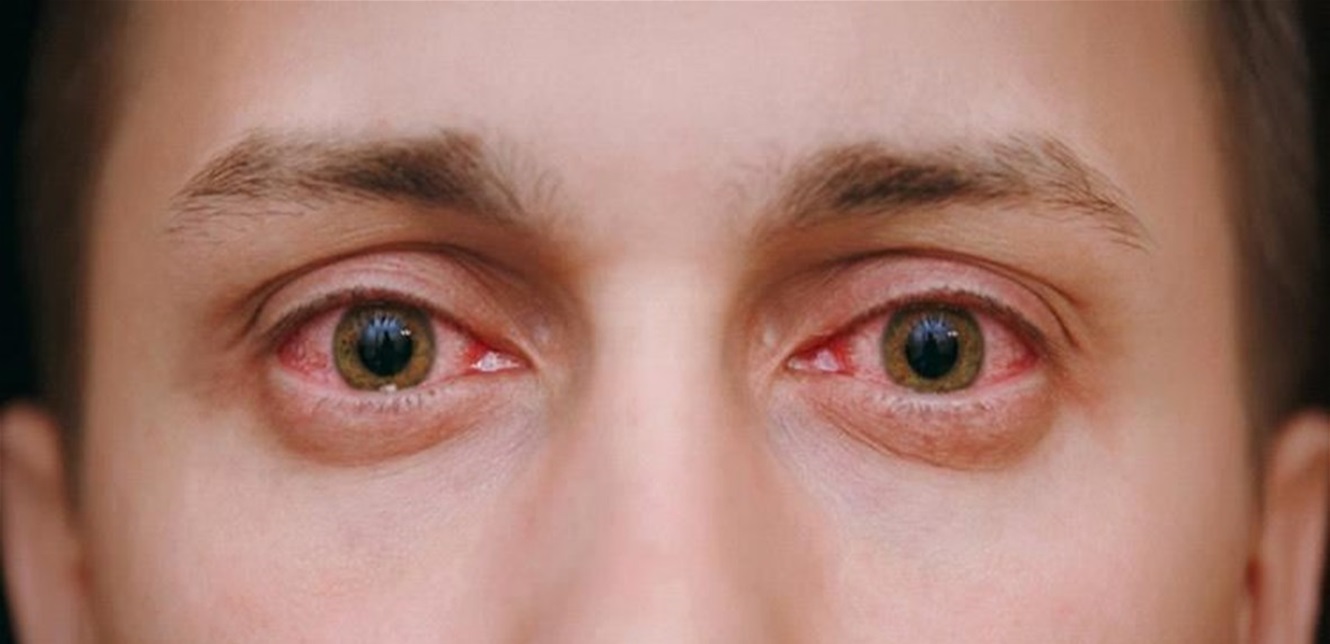 The Spreading Epidemic of Pink Eye in Vietnam, India, and Pakistan