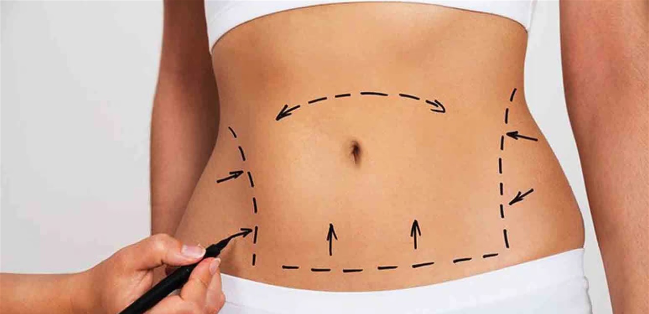 From fat to a tight figure… How have tummy tuck surgeries evolved?