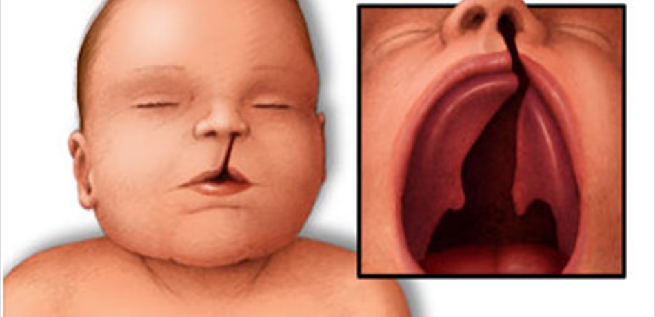 الشفة الأرنبية.. ماذا تعرفون عنها؟
