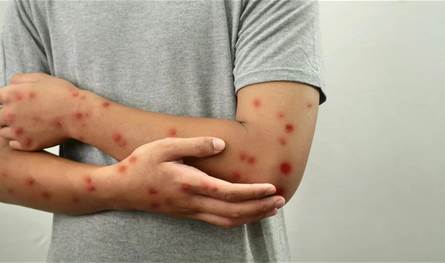 حصبة تكتسح أميركا: تسجيل نحو 900 حالة والإصابات تتزايد