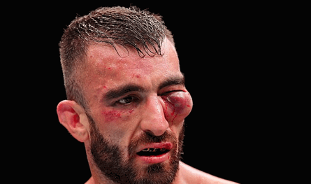 مقاتل &quot;UFC&quot; عربي يتعرض لتشويه كامل بسبب إصابات مروعة (صور)