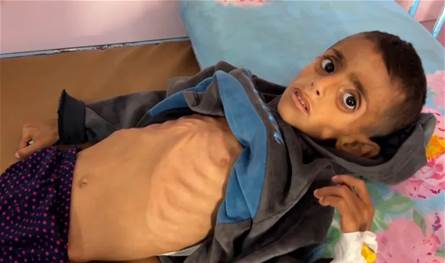 أرقام كارثية في غزة: أعلى معدل سوء تغذية بين الأطفال منذ بدء الحرب