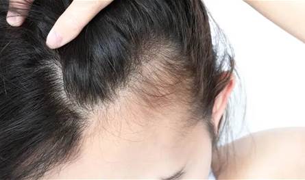 حل سحري للصلع الوراثي للرجال والنساء.. تعرفوا عليه 