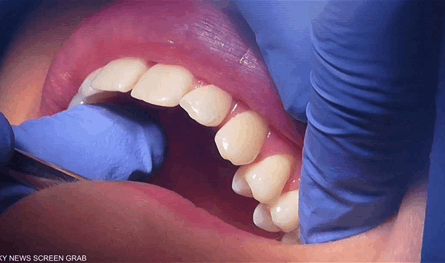 هلام ثوري يُصلح الأسنان التالفة دون جراحة