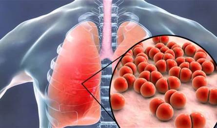 خطوة بحثية واعدة: لقاح جديد ضد السّل قيد التطوير