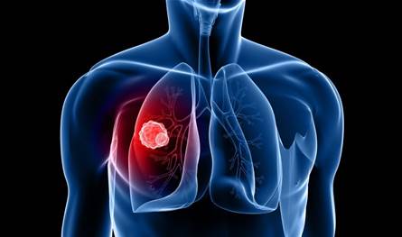 بشرى لمرضى السرطان: تقنية تعيد فعالية العلاج الكيميائي لأورام الرئة