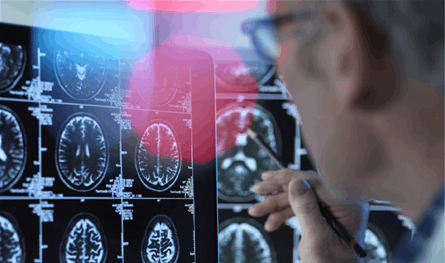 دراسة تكشف: خفض الكوليسترول يقلل خطر الإصابة بالخرف