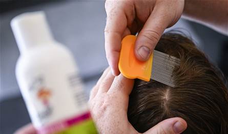 3 خطوات للتخلص من القمل.. هكذا تحمون أطفالكم