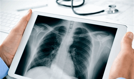 الأشعة السينية.. أداة تشخيص لا غنى عنها ومخاوف مبالغ فيها