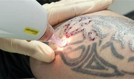 سرطان الجلد والوشم.. ما الذي تقوله الدراسات؟