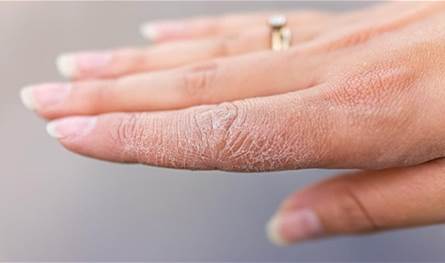 علامات مبكرة للسكري تظهر على الجلد