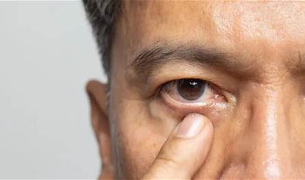 للوقاية من التأثير المدمر للغلوكوما.. اليكم آخر ما توصل اليه العلماء