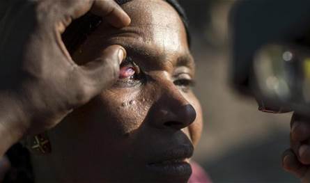 &quot;العمى النهري&quot;.. مرض خطير ينتشر في هذه الدول!