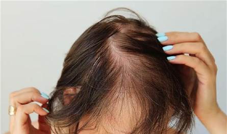 قد يتحوّل إلى عاهة مُستدامة.. فنانة شهيرة تواجه صلعاً جزئياً بسبب عها جلسة تجميل! (صورة)