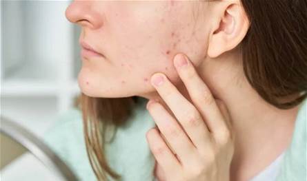 الرؤوس السوداء: أسباب وطرق الوقاية