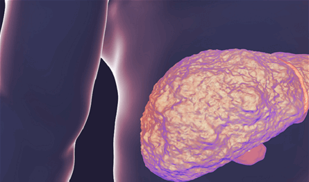 كيف يؤثر تليف الكبد على أمراض القلب؟