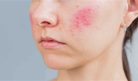 لماذا يزداد احمرار الوجه مع التقدم في العمر؟ 