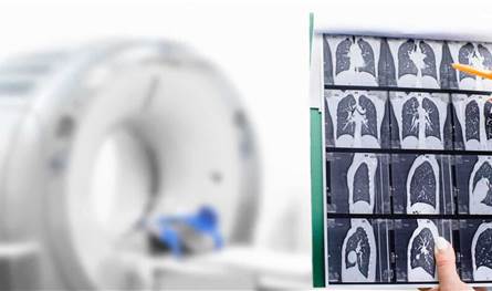 علماء يكشفون آلية جديدة قد تساهم في علاج سرطان الرئة العدواني.. تعرف إليها