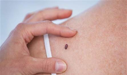 متى تصبح الشامة مقلقة؟