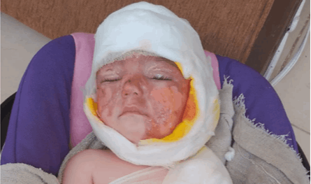 وعاء زيت غيّر طفولة ريتا.. نداء دعم لتأمين عمليات عاجلة 