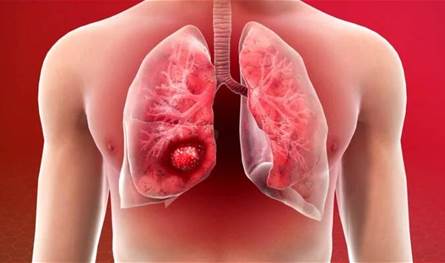 صلة خطيرة بين النظام الغذائي الحديث وسرطان الرئة… دراسة حديثة تكشفها!