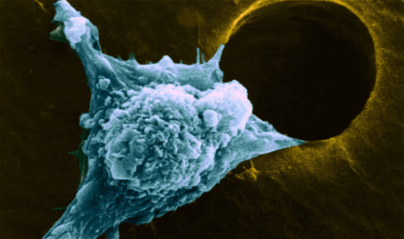 خلايا سرطانية "نائمة" بعد الشفاء.. لماذا يعود المرض فجأة؟