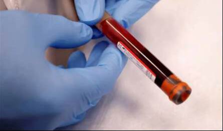 تقدّم علمي ثوري.. اختبار دم منزلي يكشف علامات مرض ألزهايمر