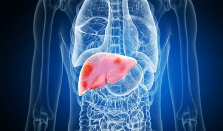 النظام الغذائي والرياضة.. مفتاح صحة الكبد