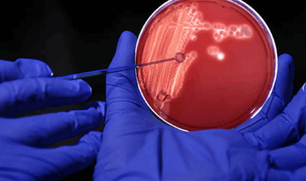 دراسة كورية تربط بكتيريا تسوس الأسنان بمرض باركنسون