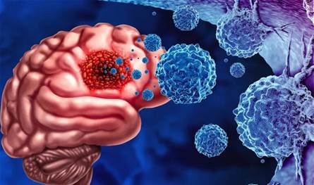 أورام الدماغ بين الأولية والثانوية… وهذه أبرز الإشارات التحذيرية