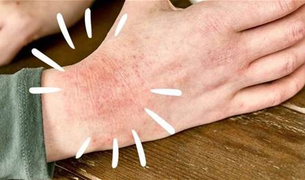 نصائح للتخلص من مشكلة إكزيما الشتاء.. هذا ما يجب فعله