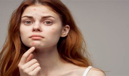 لماذا يزداد حب الشباب في الشتاء؟ حلول فعّالة للحفاظ على صحة البشرة