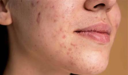 "عدو الشتاء الخفي".. لماذا يهاجم حب الشباب بشرتكِ مع برودة الجو؟