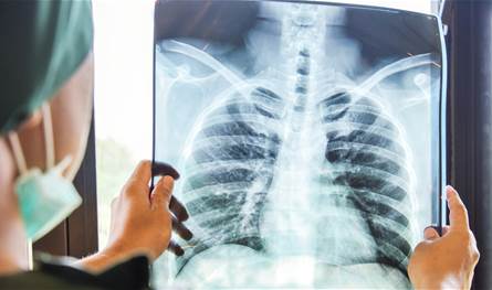 مع الحرب والنزوح… هل يزداد خطر الإصابة بمرض السّل؟