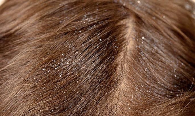 Dandruff in the fall: its causes and how to care for it