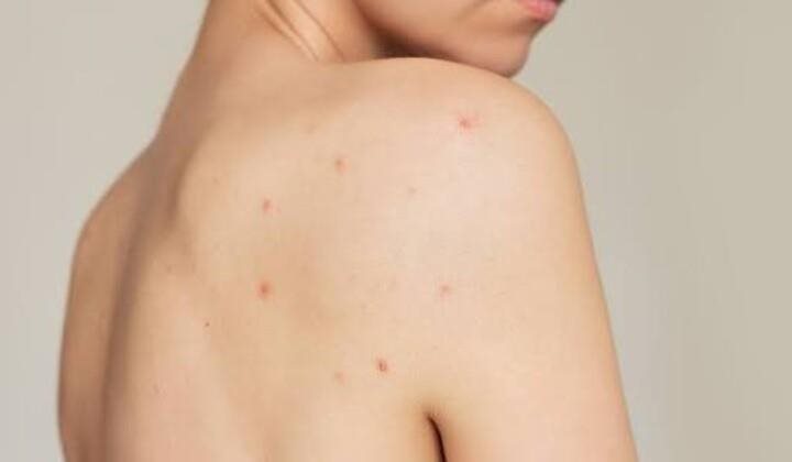 Does showering after sweating prevent back acne?