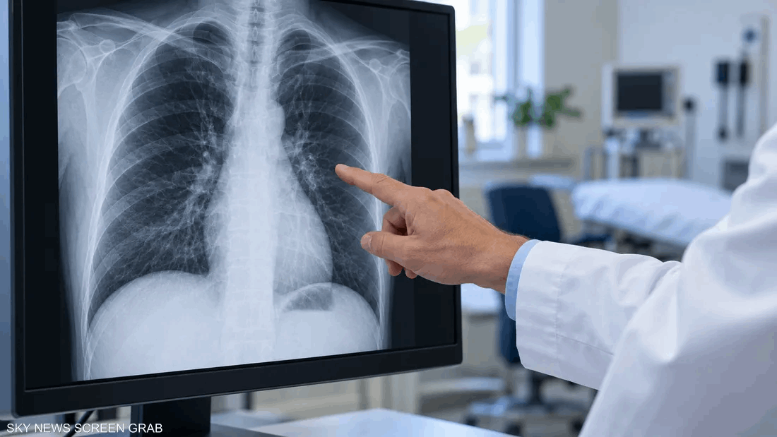 Before Lung Cancer Progresses… A Treatment Combination Extends Survival